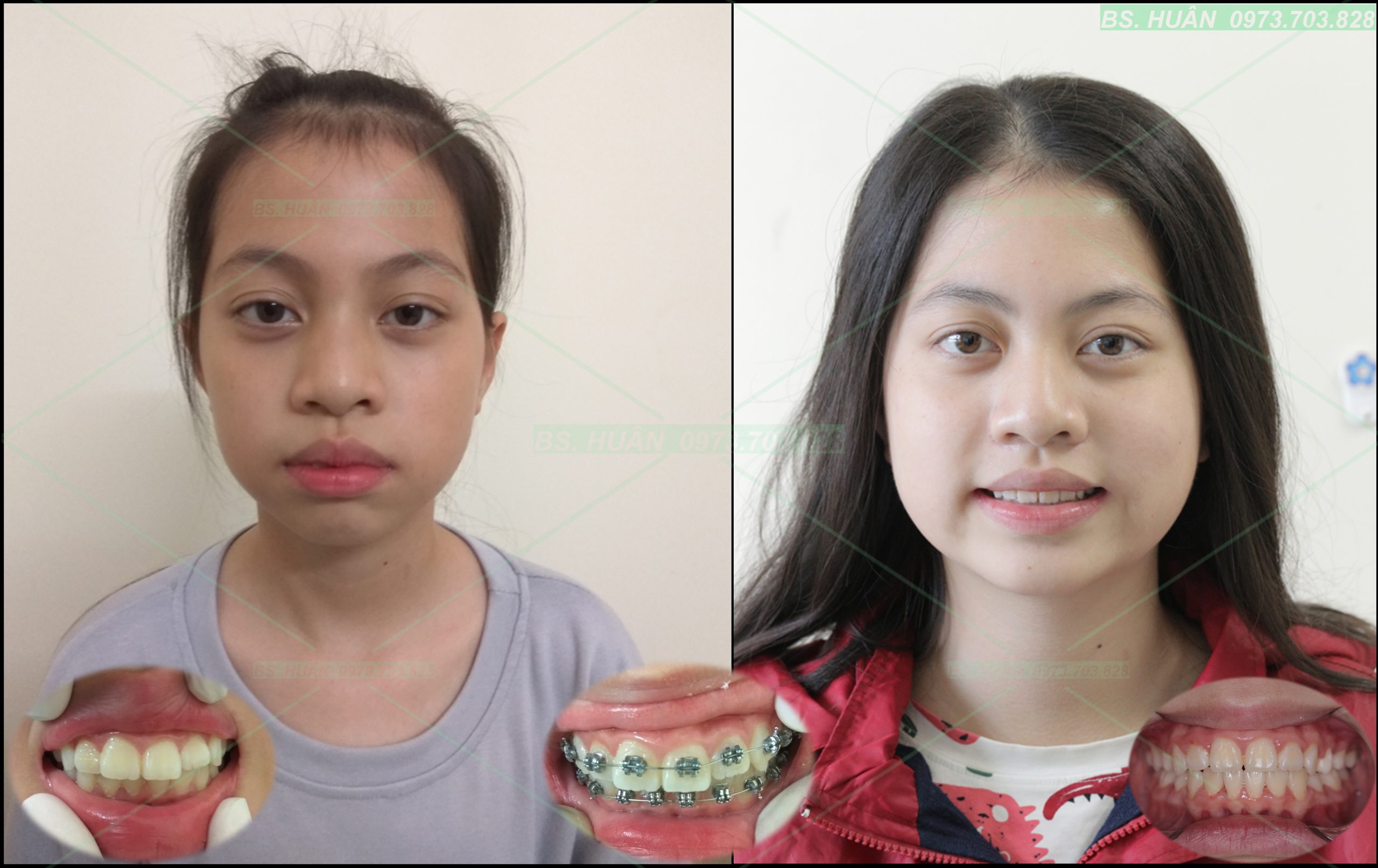 Chỉnh nha Đ.T.D