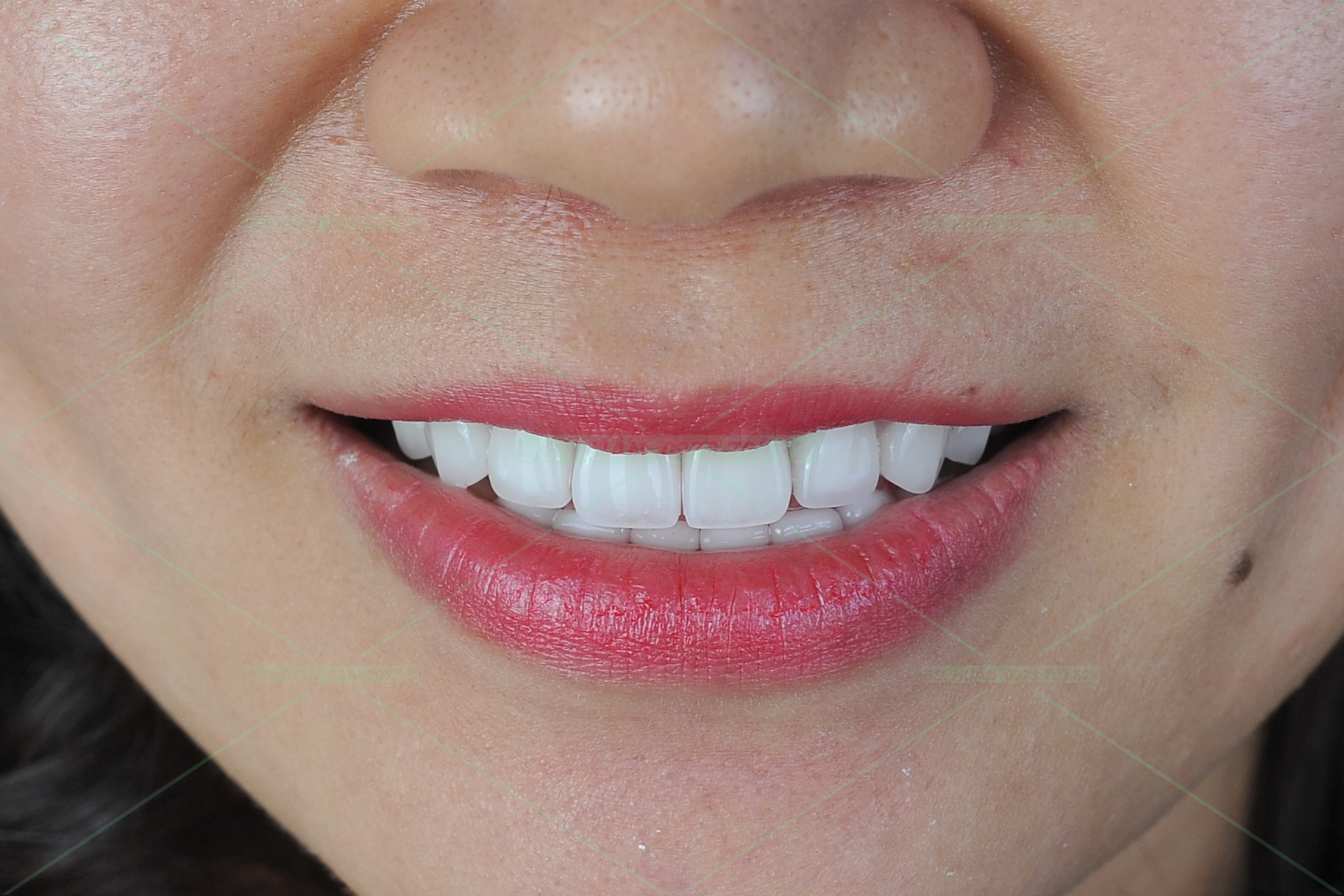 Răng sứ thẩm mỹ – P.T.H