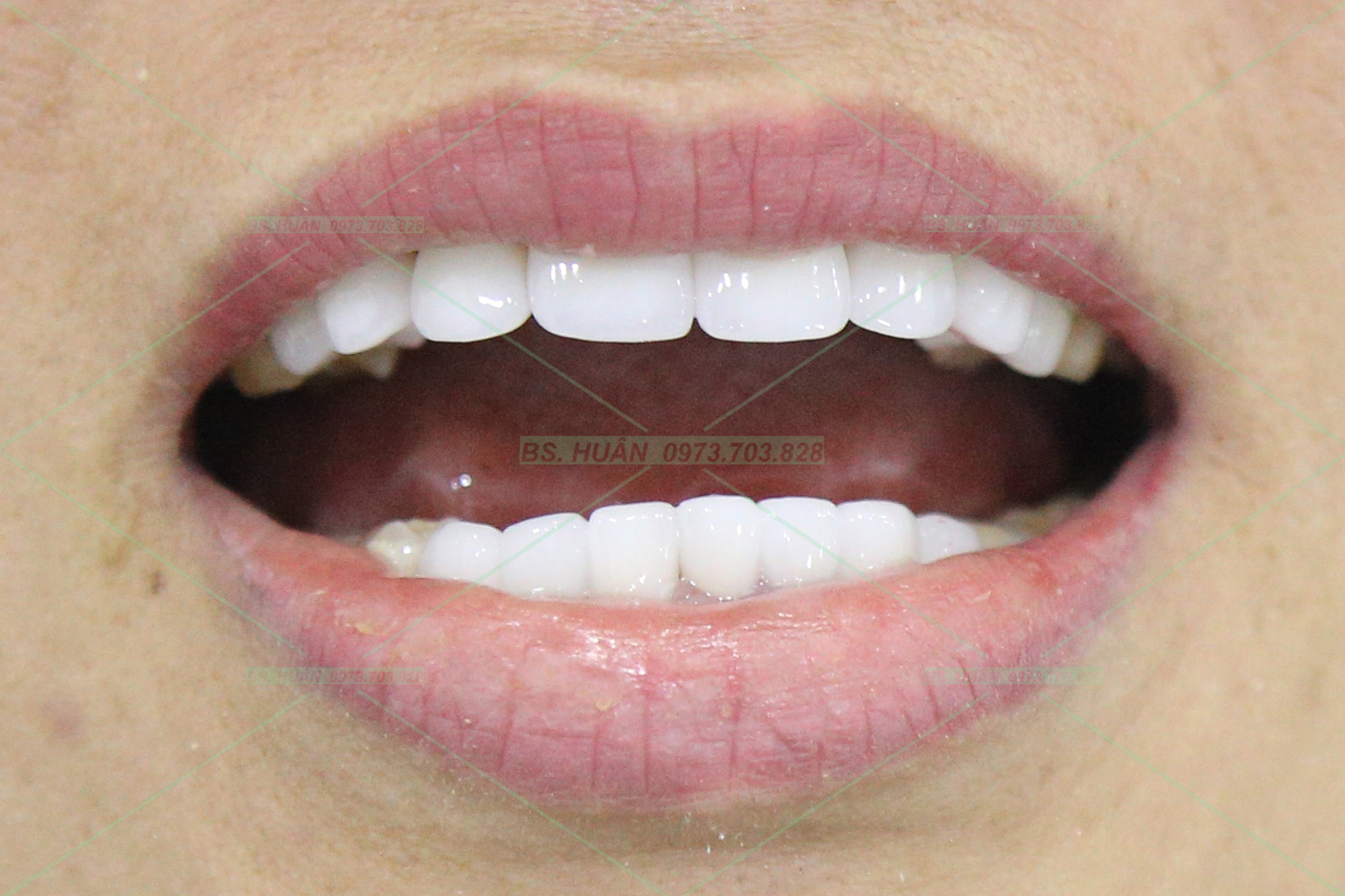 Răng sứ thẩm mỹ – N.T.B