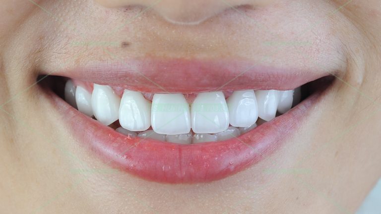 Răng sứ thẩm mỹ – Đ.T.H