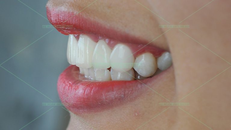 Răng sứ thẩm mỹ – N.T.L