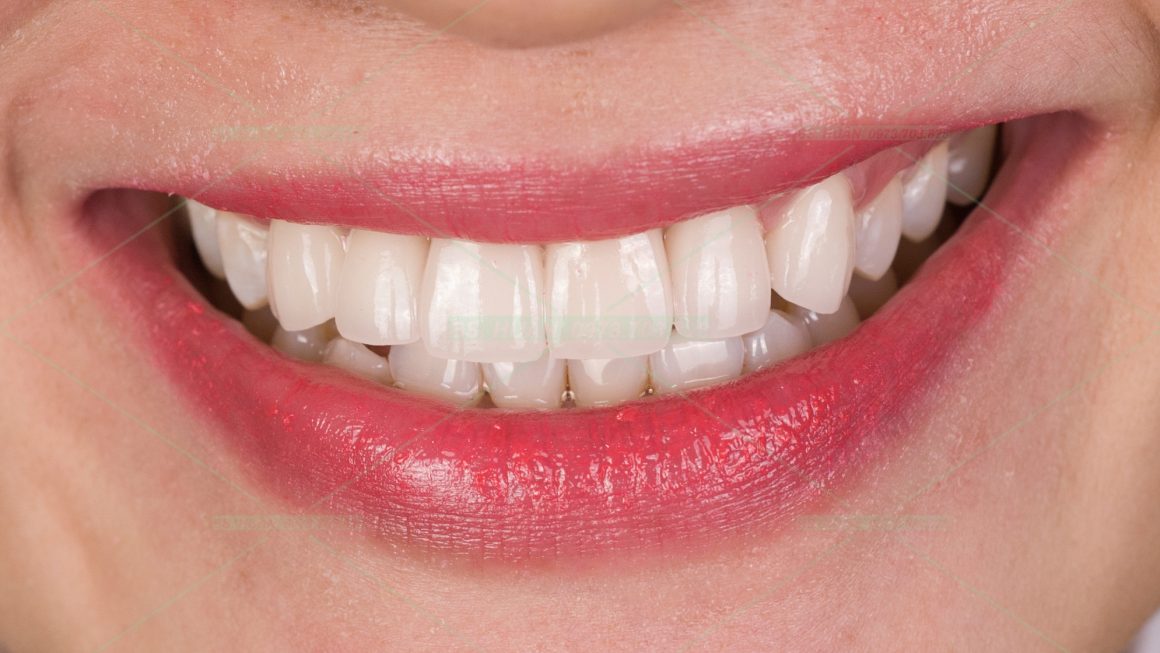 Răng sứ thẩm mỹ T.H.Y