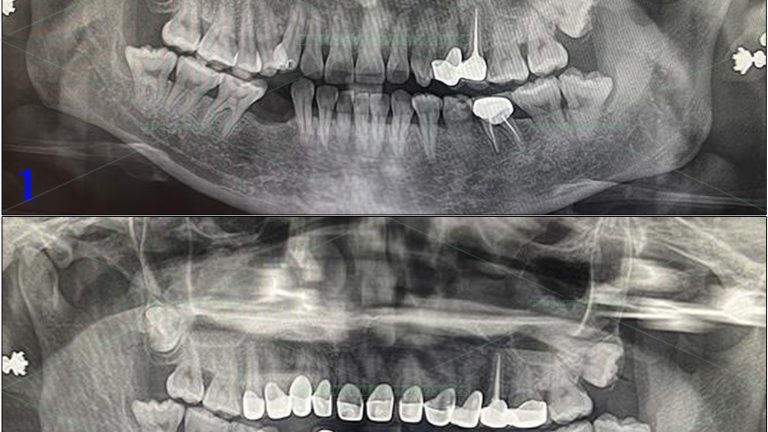 Implant – 1 số ca P1