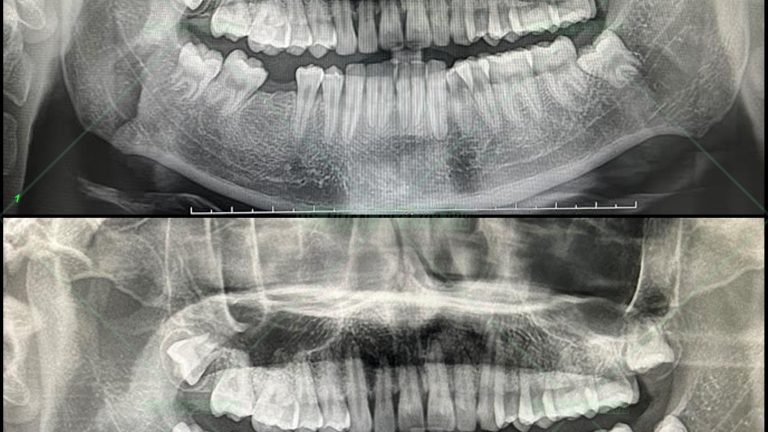 Implant – 1 số ca P2