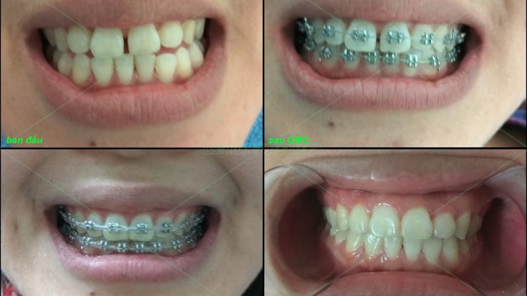 Chỉnh nha – 1 số ca lẻ P2