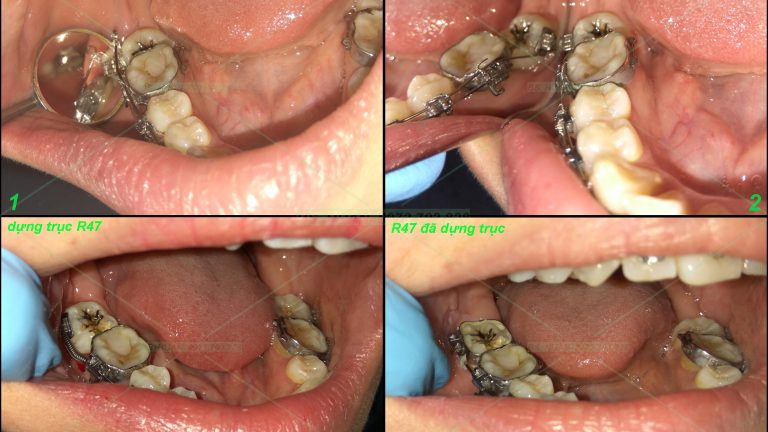 Chỉnh nha – 1 số ca lẻ P1