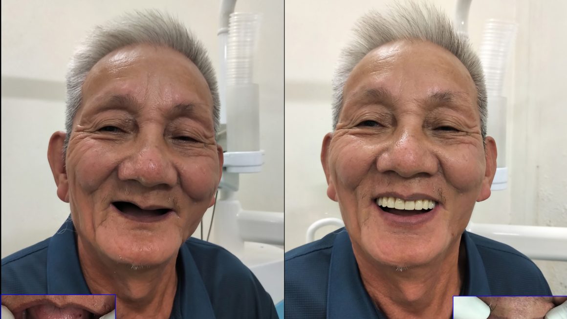 Implant – Phục hồi răng mất 2 hàm cho bác cựu chiến binh năm xưa