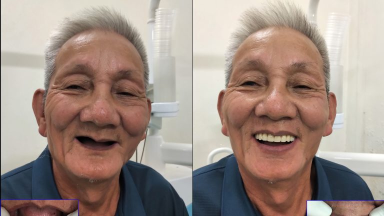 Implant – Phục hồi răng mất 2 hàm cho bác cựu chiến binh năm xưa